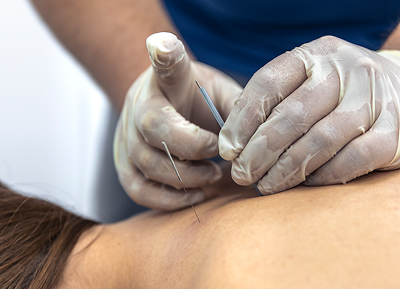 Acupuncture Needling