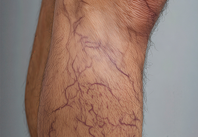 Varicose Vein Treatment